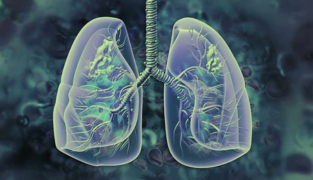 lung-cancer